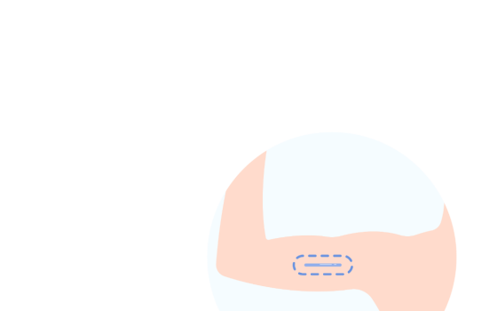 implant